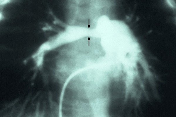 X-ray angiocardiogram of right pulmonary artery showing stenosis contstriction caused by the patient’s mother contracting Rubella (German Measles) during pregnancy. Photo courtesy CDC / Dr. Andre J. Lebrun